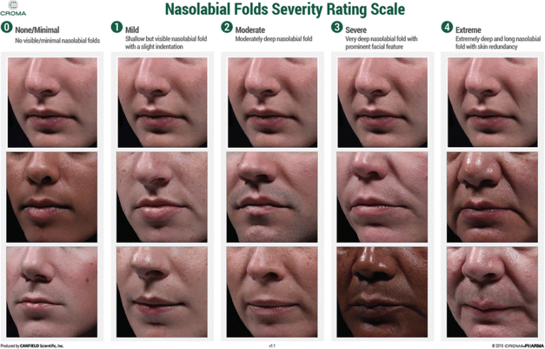 Nasolabial Fold Filler