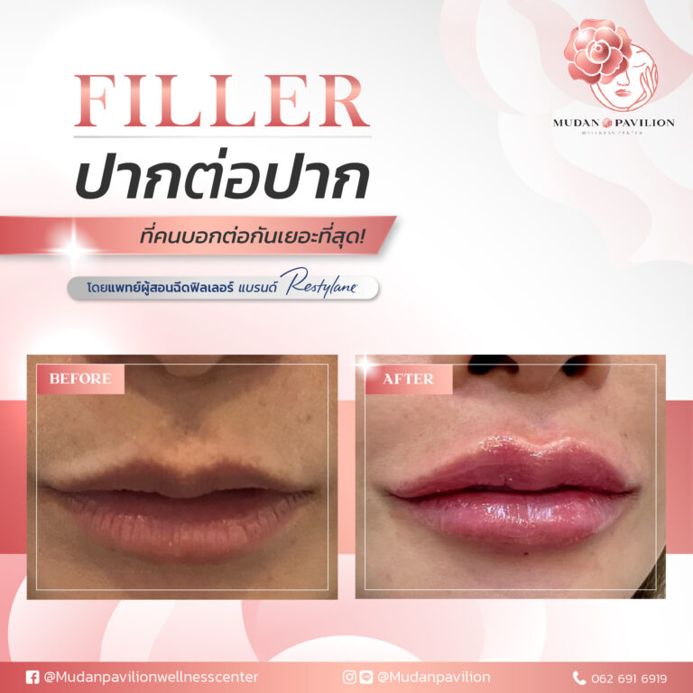The most popular word-of-mouth filler!