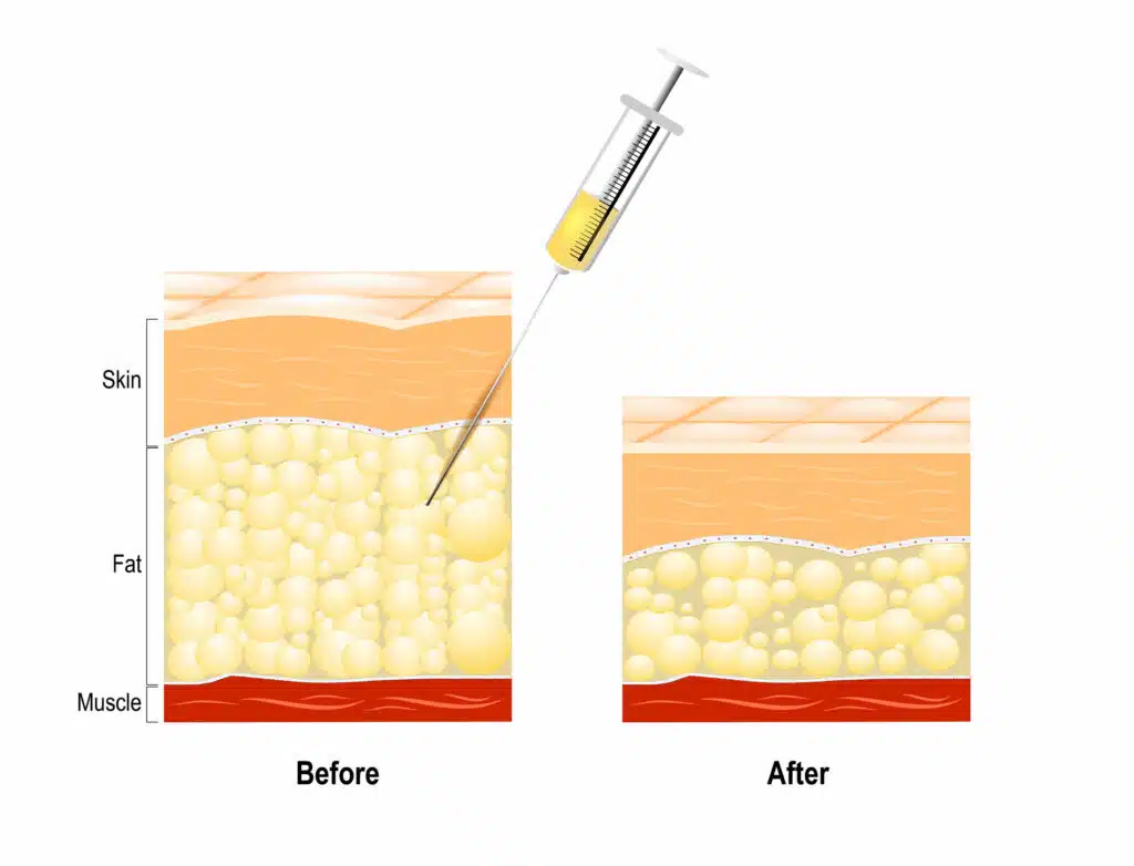 how-do-meso-fat-injections-work-1024x782